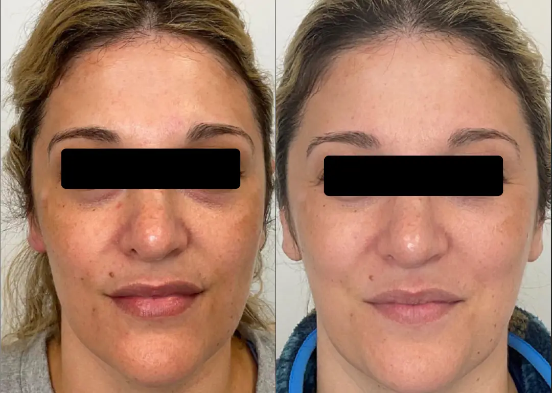 before after microneedling