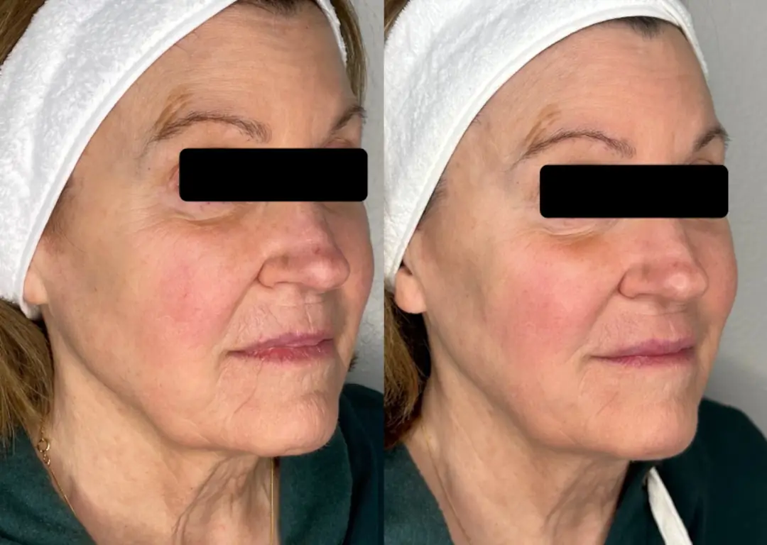 before after microneedling