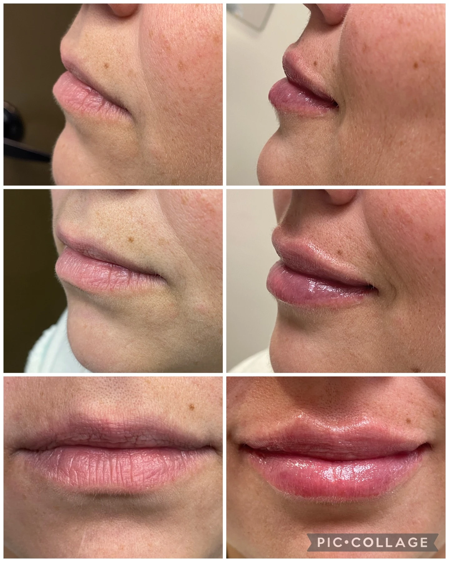 filler before and after