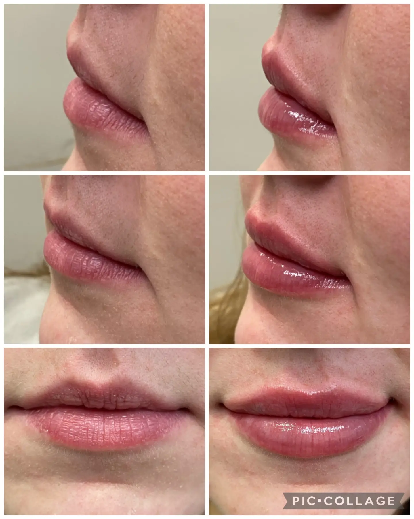 filler before and after